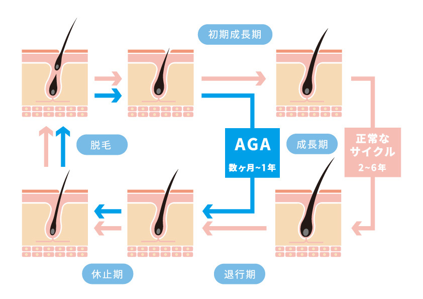 AGAのメカニズム